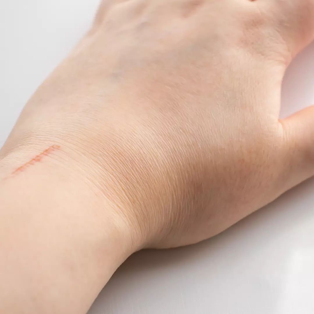 Laser Scar Removal to Help You Feel Confident Again